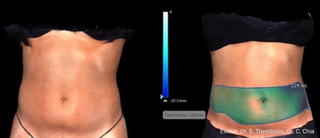 image showing targeted area of belly for body sculpting
